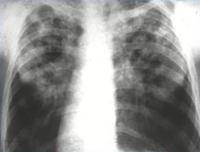 Причины и лечение милиарного туберкулеза