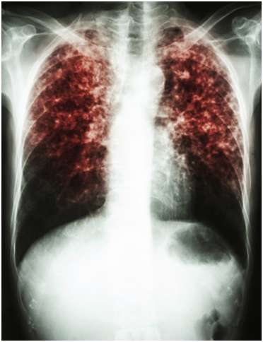 В чем опасность вторичной формы туберкулеза и можно ли ее полностью вылечить?
