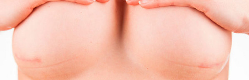 Виды шрамов после подтяжки груди и как их избежать
