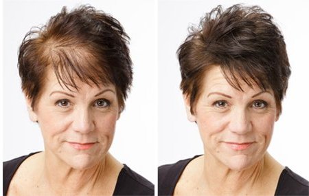 мезотерапия головы - фото до и после