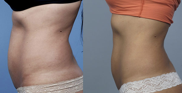 Фото до и после похудения с липолитиками