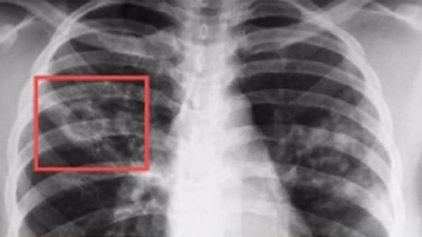 Почему развивается очаговый туберкулез легких?