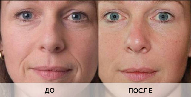 фото до и после биоревитализации глаз