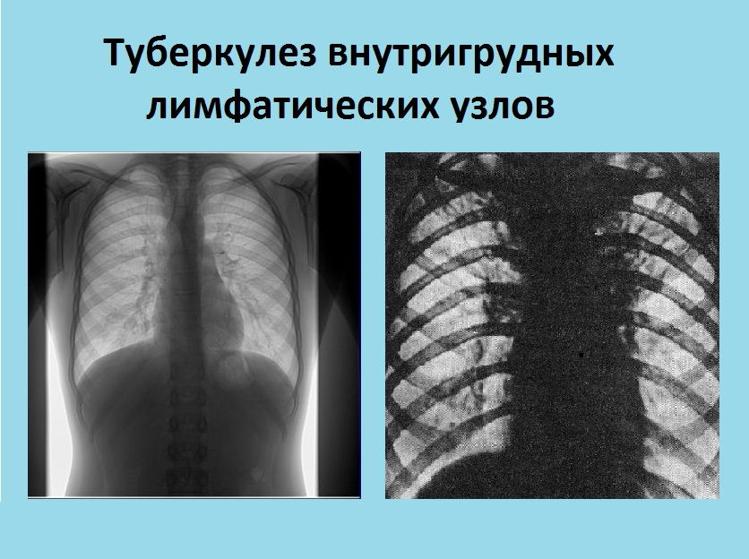 Как проявляется туберкулез внутригрудных лимфатических узлов?