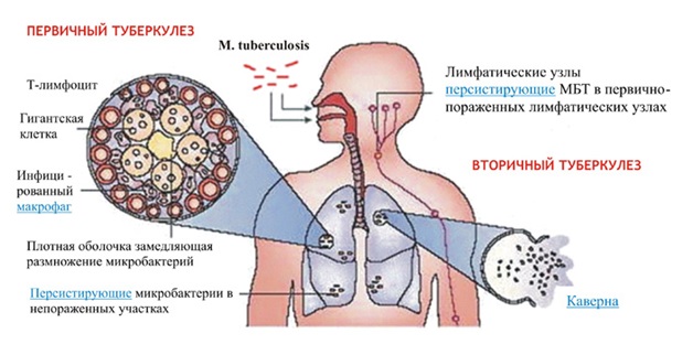 Этиология и патогенез туберкулеза