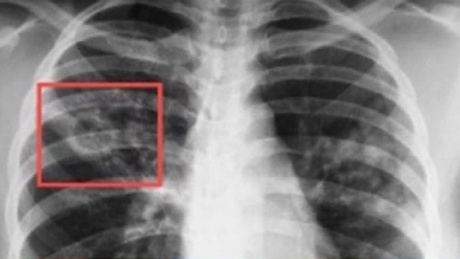 Флюорография при туберкулезе эффективный метод диагностики