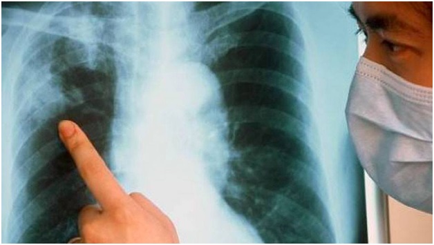 Что такое открытая форма туберкулеза и насколько она опасна?