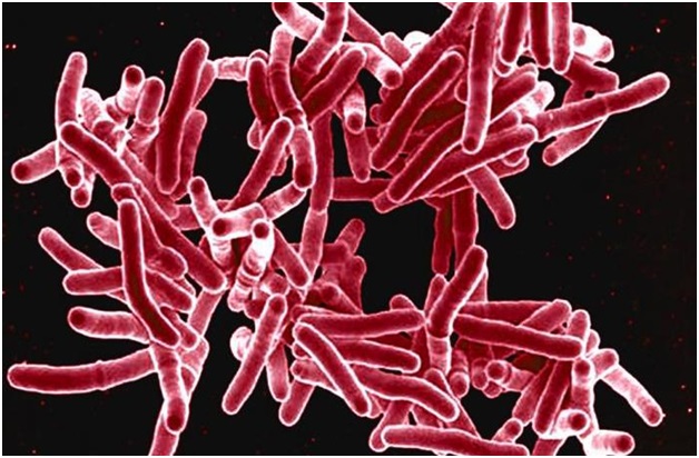 Что такое первичный туберкулез и как избежать заболевания?