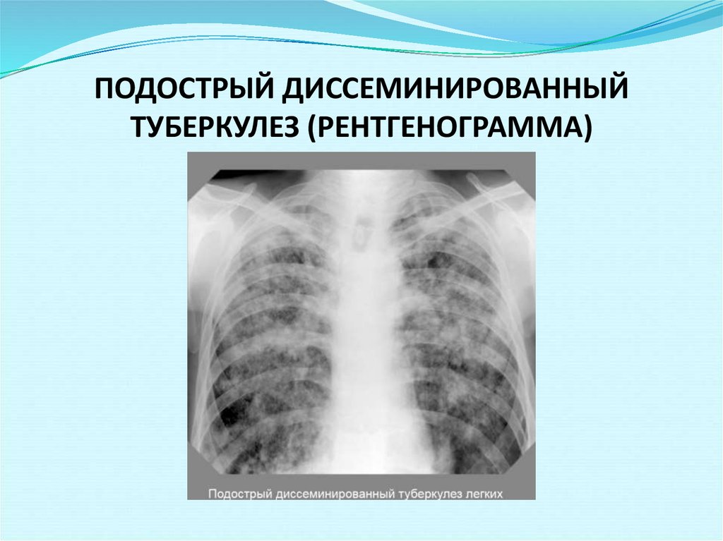 Что такое диссеминированный туберкулез?