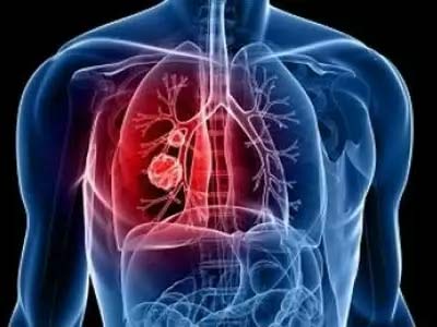 Что такое туберкулома легких?