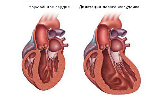 Желудочка сердца расширена. Дилатация ЛП сердца что это такое. Расширение камер сердца. Дилатация камер сердца. Дилатация левого желудочка.