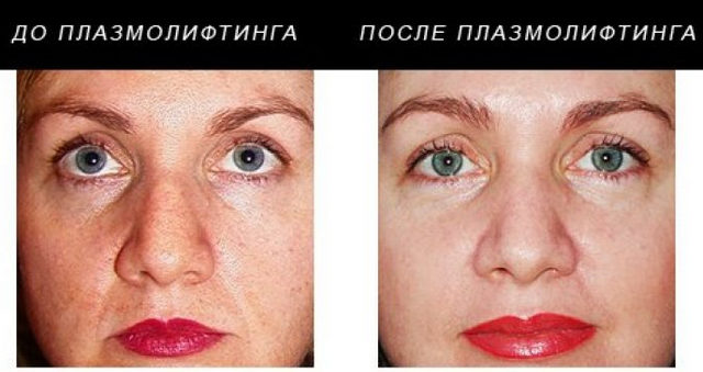 плазмолифтинг лица до и после