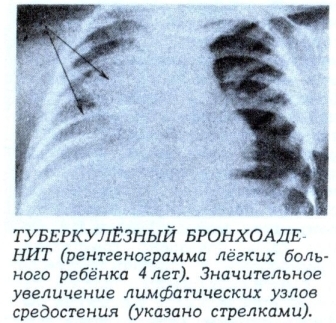 Туберкулезный бронхоаденит причины и прогноз выздоровления