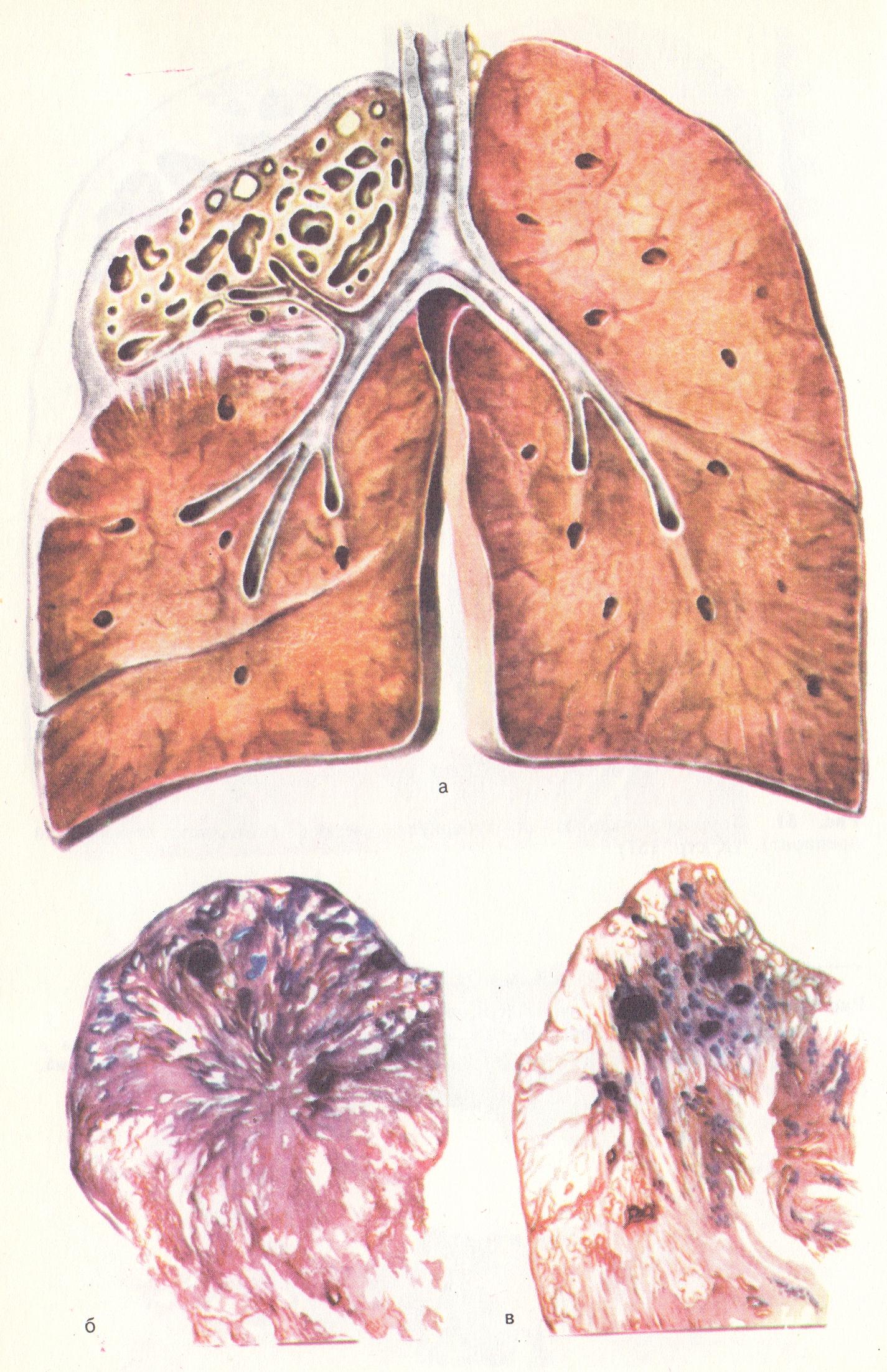 Что такое цирротический туберкулез легких?