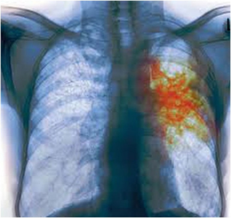 Туберкулезный бронхоаденит причины и прогноз выздоровления