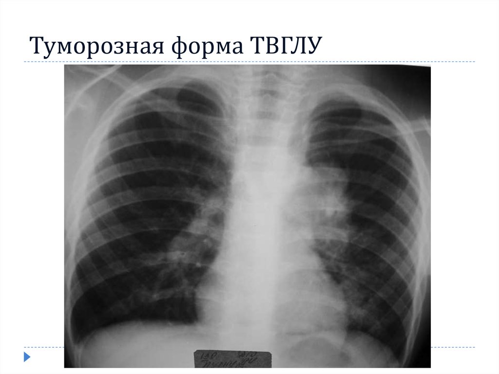 Как проявляется туберкулез внутригрудных лимфатических узлов?