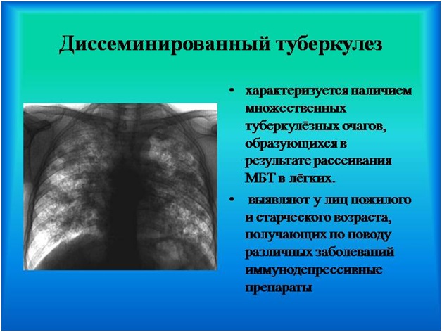 Значимость рентгенографии при туберкулезе