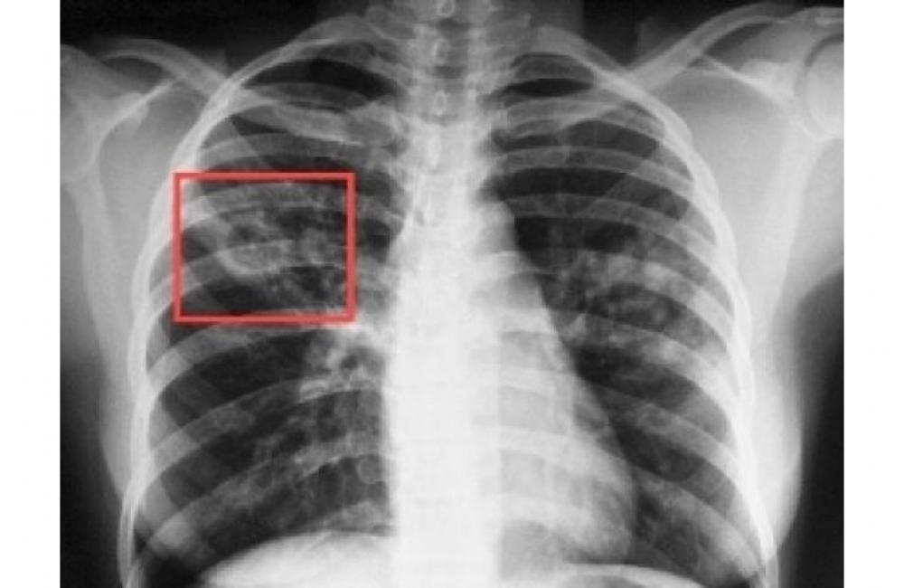 Описание стадий туберкулеза от первой и до последней