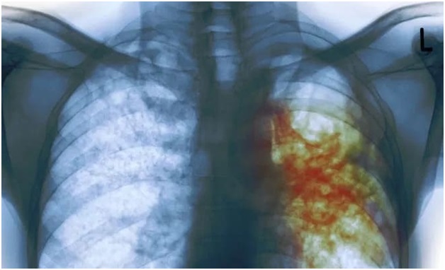 Что представляет собой закрытая форма туберкулеза и в чем ее опасность?