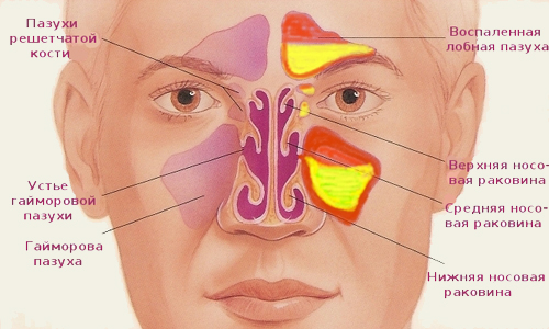 Как снять отек слизистой носа во время насморка?