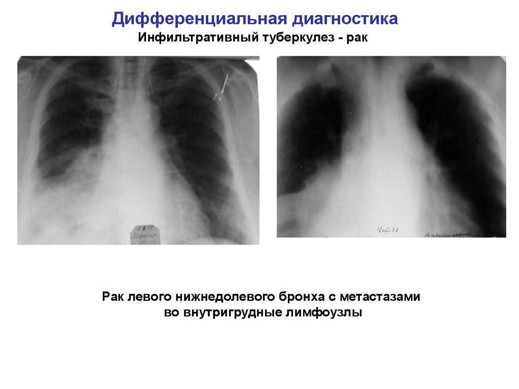Как проводится дифференциальная диагностика туберкулеза?