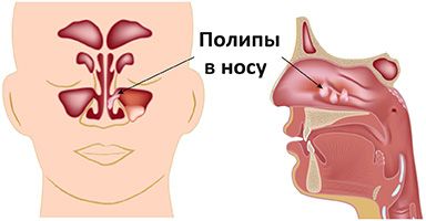 Удаление полипов в носу: когда нужна операция, как проводится